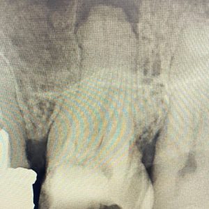 endodontie-traitement-dentaire-montesson