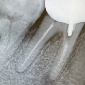 endodontie-dent-patient-traitement