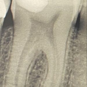 radiographie-cicatrisation-dentisterie